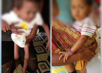 Melalui Inovasi Garpu Genting, Kini Miska Tumbuh Normal