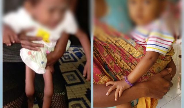 Melalui Inovasi Garpu Genting, Kini Miska Tumbuh Normal